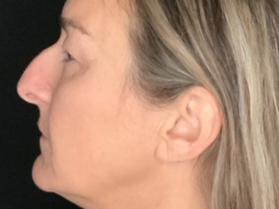 Patient #85874: Upper Blepharoplasty with Browpexy and Facial Fat Injections Before Image