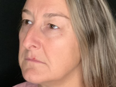 Patient #85874: Upper Blepharoplasty with Browpexy and Facial Fat Injections Before Image