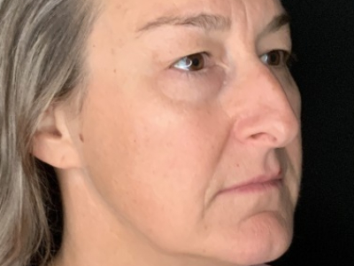Patient #85874: Upper Blepharoplasty with Browpexy and Facial Fat Injections Before Image
