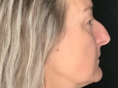 Patient #85874: Upper Blepharoplasty with Browpexy and Facial Fat Injections Before Image