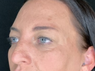 Paciente n.° 37854: Imagen previa a la blefaroplastia