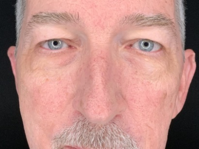 Patient #63258: Upper Blepharoplasty with Facial Fat Injections Before Image