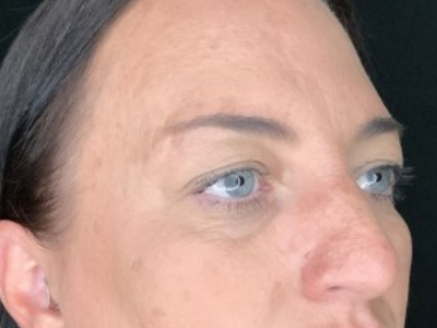 Paciente n.° 37854: Imagen previa a la blefaroplastia