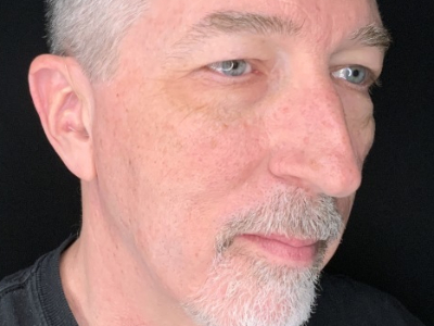 Patient #63258: Upper Blepharoplasty with Facial Fat Injections Before Image