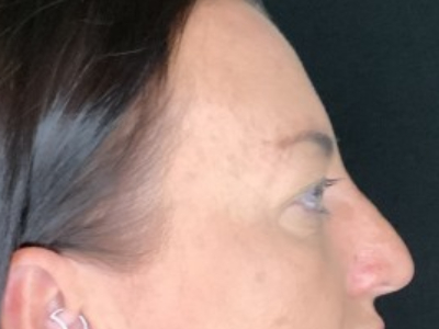 Paciente n.° 37854: Imagen previa a la blefaroplastia