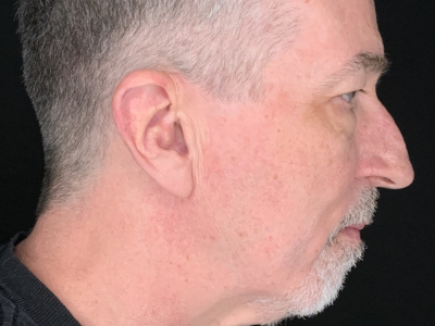 Patient #63258: Upper Blepharoplasty with Facial Fat Injections Before Image