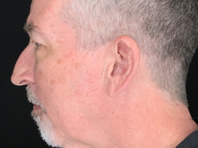 Patient #63258: Upper Blepharoplasty with Facial Fat Injections Before Image