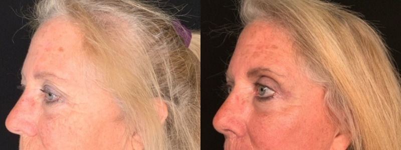 Patient #35246: Upper Blepharoplasty with Browpexy Combine Image