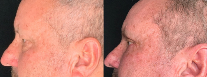 Patient #54139: Upper Blepharoplasty with Browpexy and Lower Blepharoplasty with Fat Injections Combine Image