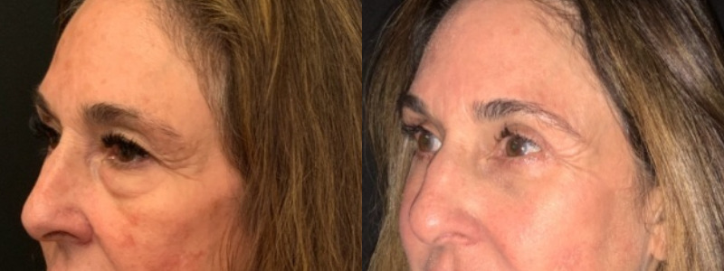 Patient #27952: Upper & Lower Blepharoplasty with Browpexy & Facial Fat Injections Combine Image