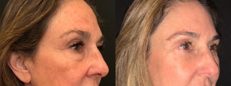 Patient #27952: Upper & Lower Blepharoplasty with Browpexy & Facial Fat Injections Combine Image