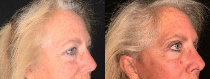 Patient #35246: Upper Blepharoplasty with Browpexy Combine Image