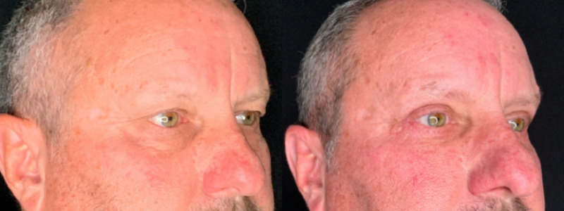 Patient #54139: Upper Blepharoplasty with Browpexy and Lower Blepharoplasty with Fat Injections Combine Image