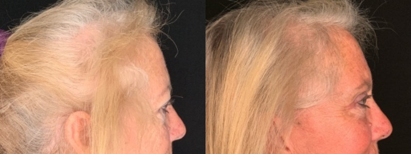 Patient #35246: Upper Blepharoplasty with Browpexy Combine Image