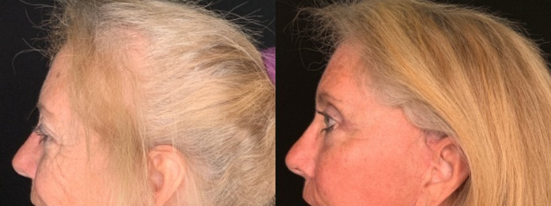 Patient #35246: Upper Blepharoplasty with Browpexy Combine Image