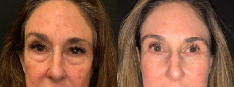 Patient #27952: Upper & Lower Blepharoplasty with Browpexy & Facial Fat Injections Combine Image