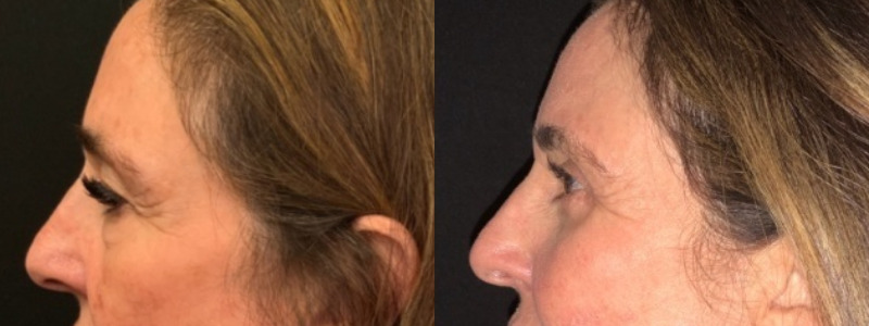 Patient #27952: Upper & Lower Blepharoplasty with Browpexy & Facial Fat Injections Combine Image