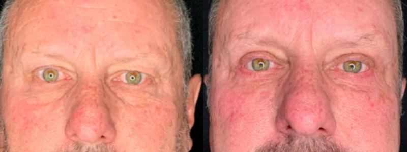 Patient #54139: Upper Blepharoplasty with Browpexy and Lower Blepharoplasty with Fat Injections Combine Image