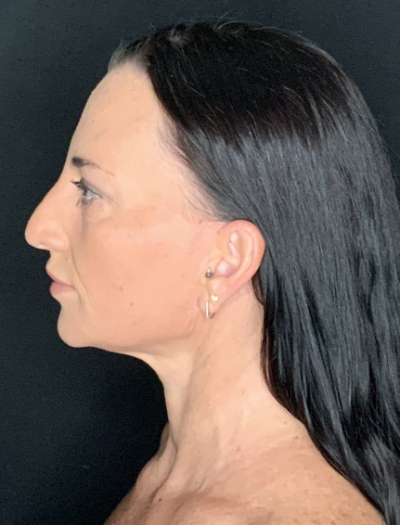 Patient #37854: Facelift with Neck Lift, Fat Injections, and Upper Blepharoplasty After Image