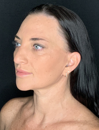 Patient #37854: Facelift with Neck Lift, Fat Injections, and Upper Blepharoplasty After Image