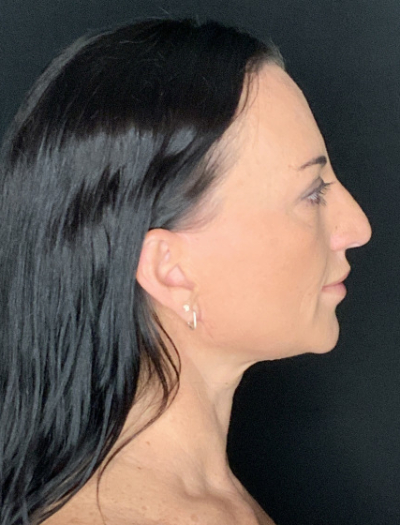 Patient #37854: Facelift with Neck Lift, Fat Injections, and Upper Blepharoplasty After Image