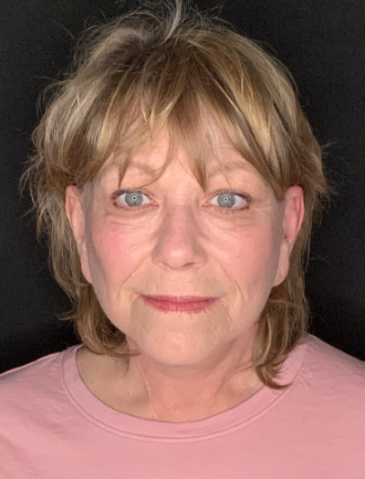 Patient #96745: Facelift with Neck Lift and Fat Injections After Image