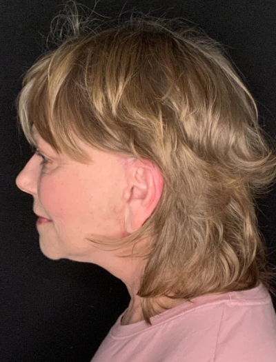 Patient #96745: Facelift with Neck Lift and Fat Injections After Image