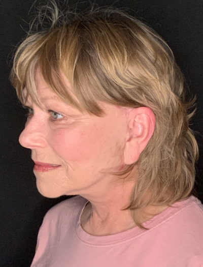 Patient #96745: Facelift with Neck Lift and Fat Injections After Image