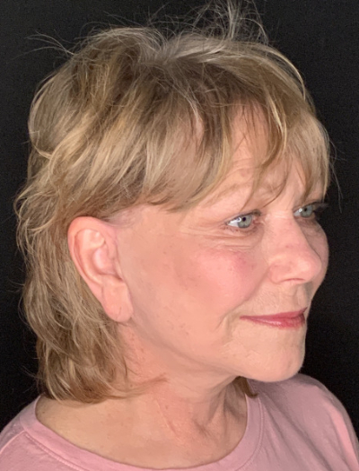 Patient #96745: Facelift with Neck Lift and Fat Injections After Image