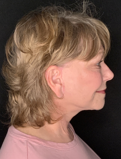 Patient #96745: Facelift with Neck Lift and Fat Injections After Image
