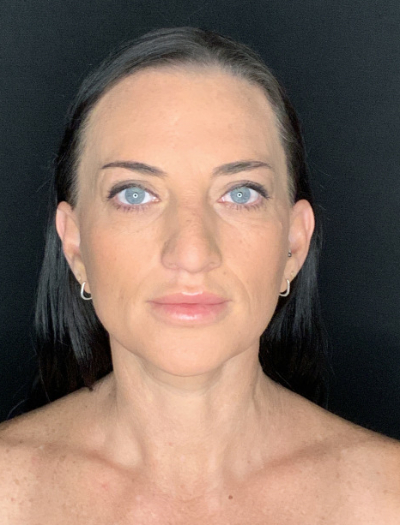 Patient #37854: Facelift with Neck Lift, Fat Injections, and Upper Blepharoplasty After Image