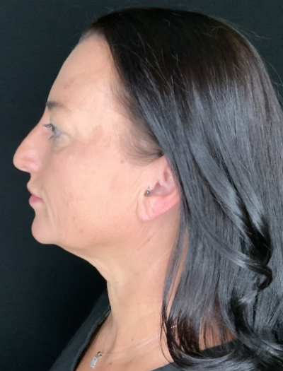 Patient #37854: Facelift with Neck Lift, Fat Injections, and Upper Blepharoplasty Before Image