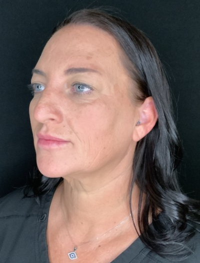 Patient #37854: Facelift with Neck Lift, Fat Injections, and Upper Blepharoplasty Before Image