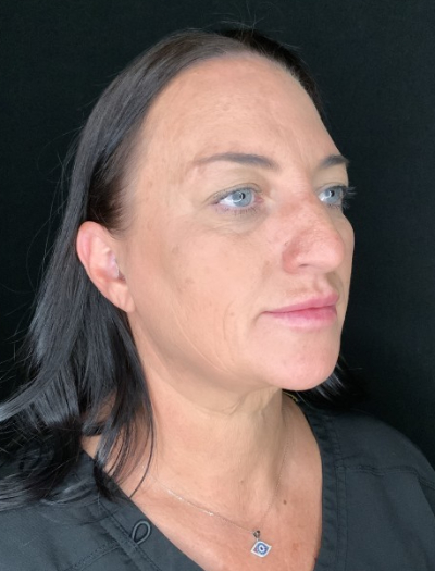 Patient #37854: Facelift with Neck Lift, Fat Injections, and Upper Blepharoplasty Before Image