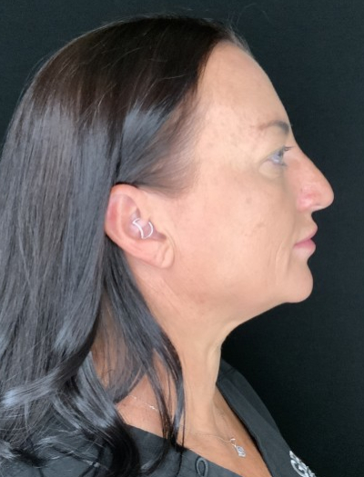 Patient #37854: Facelift with Neck Lift, Fat Injections, and Upper Blepharoplasty Before Image