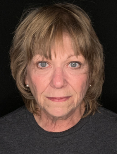 Patient #96745: Facelift with Neck Lift and Fat Injections Before Image