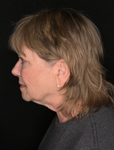 Patient #96745: Facelift with Neck Lift and Fat Injections Before Image