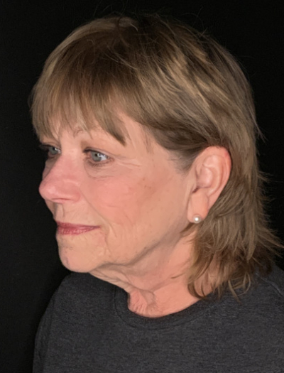 Patient #96745: Facelift with Neck Lift and Fat Injections Before Image