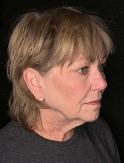 Patient #96745: Facelift with Neck Lift and Fat Injections Before Image
