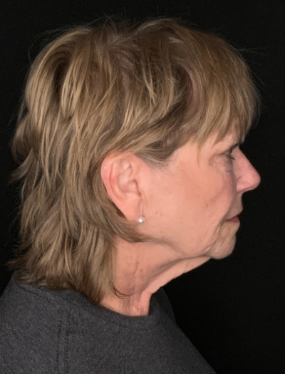 Patient #96745: Facelift with Neck Lift and Fat Injections Before Image