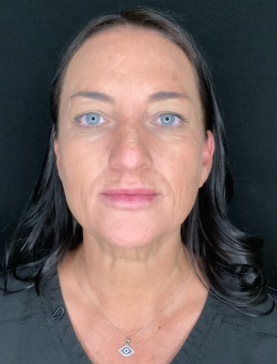 Patient #37854: Facelift with Neck Lift, Fat Injections, and Upper Blepharoplasty Before Image