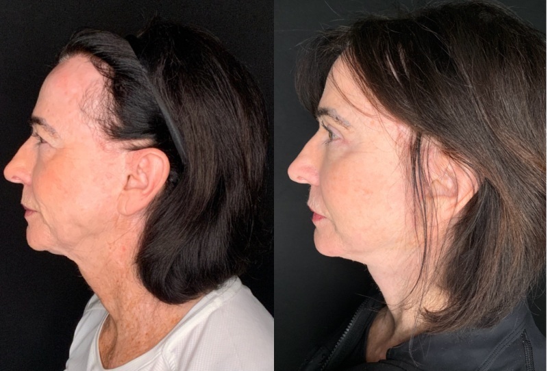 Patient #14569: Facelift with Neck Lift, Facial Fat Injections, Upper Bleharoplasty, Brow Lift, & CO2 Resurfacing Combine Image