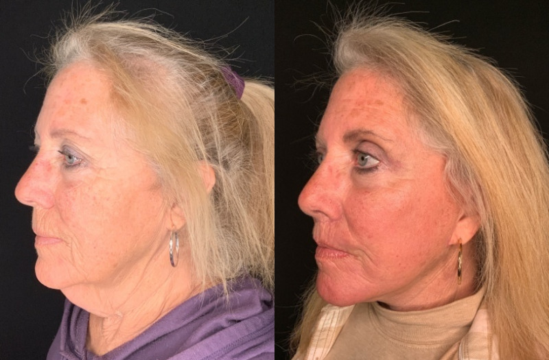 Patient #35246: Facelift with Lip Lift, Facial Fat Injections, CO2 Laser, and Upper Blepharoplasty Combine Image