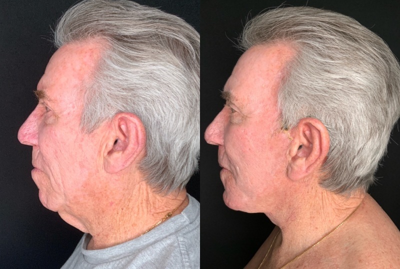 Patient #54698: Facelift with Chin Augmentation, Facial Implants and Fat Injections, and Resurfacing Combine Image