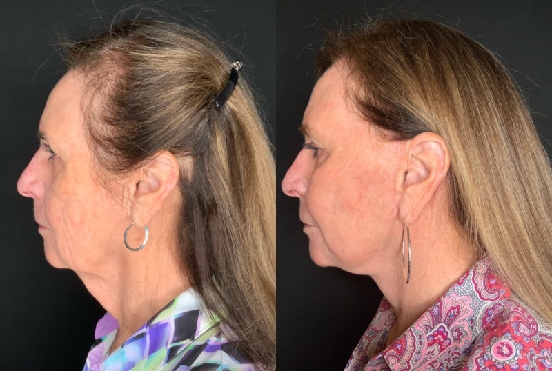 Patient #66996: Facelift with Laser Resurfacing and Facial Fat Injections Combine Image
