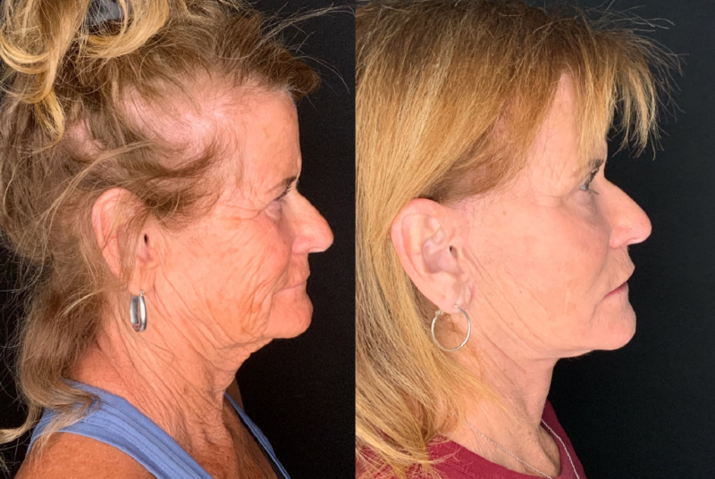 Patient #57974: Facelift with Platysmaplasty, Facial Fat Injections, Bilateral Upper Blepharoplasty, and Endoscopic Browlift Combine Image