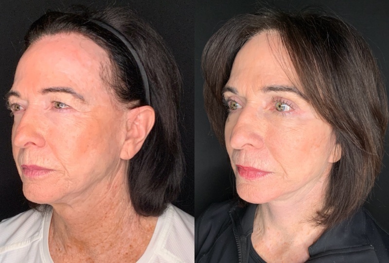 Patient #14569: Facelift with Neck Lift, Facial Fat Injections, Upper Bleharoplasty, Brow Lift, & CO2 Resurfacing Combine Image