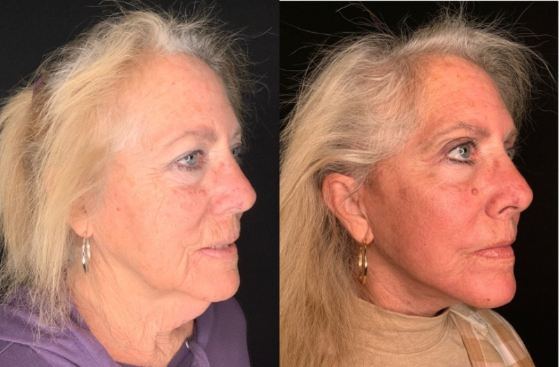 Patient #35246: Facelift with Lip Lift, Facial Fat Injections, CO2 Laser, and Upper Blepharoplasty Combine Image