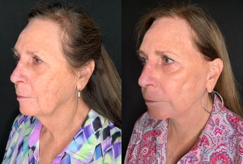 Patient #66996: Facelift with Laser Resurfacing and Facial Fat Injections Combine Image