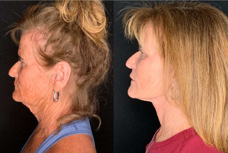 Patient #57974: Facelift with Platysmaplasty, Facial Fat Injections, Bilateral Upper Blepharoplasty, and Endoscopic Browlift Combine Image